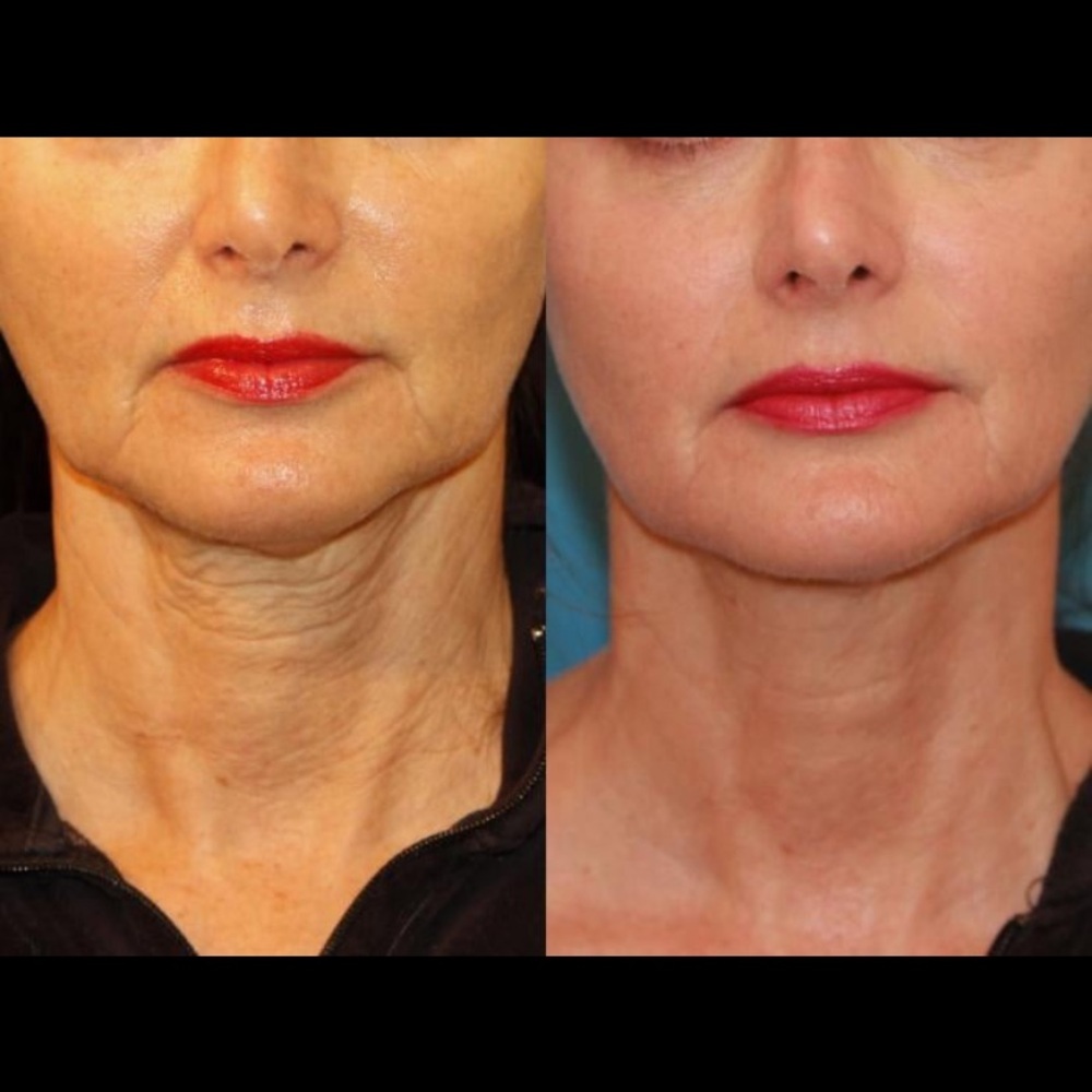 Professional PLLA Collagen Booster
- Volumizing & Skin Firming (1
Sealed Vial)